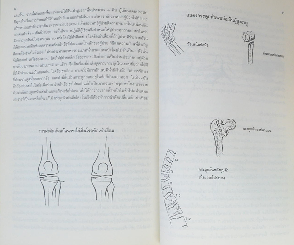 ขุนฉันทศาสตร์โกศล (ปัญหาเรื่องกระดูกและข้อในคนสูงอายุ อุบัติเหตุในผู้สูงอายุและวิธีป้องกัน)