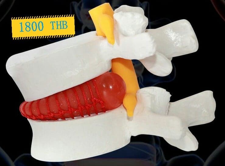 โมเดลจำลองหมอนรองกระดูกสันหลังทับเส้นประสาท (Disc herniation model)