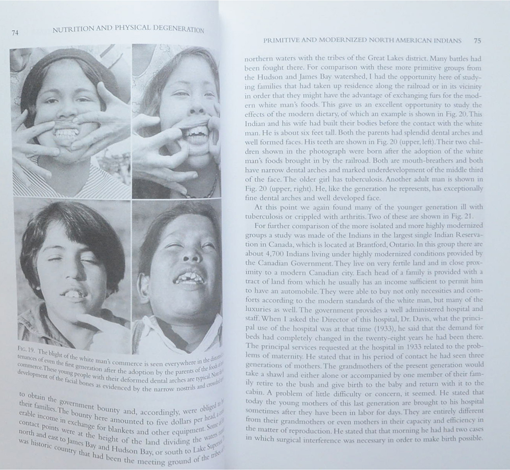 Nutrition and Physical Degeneration