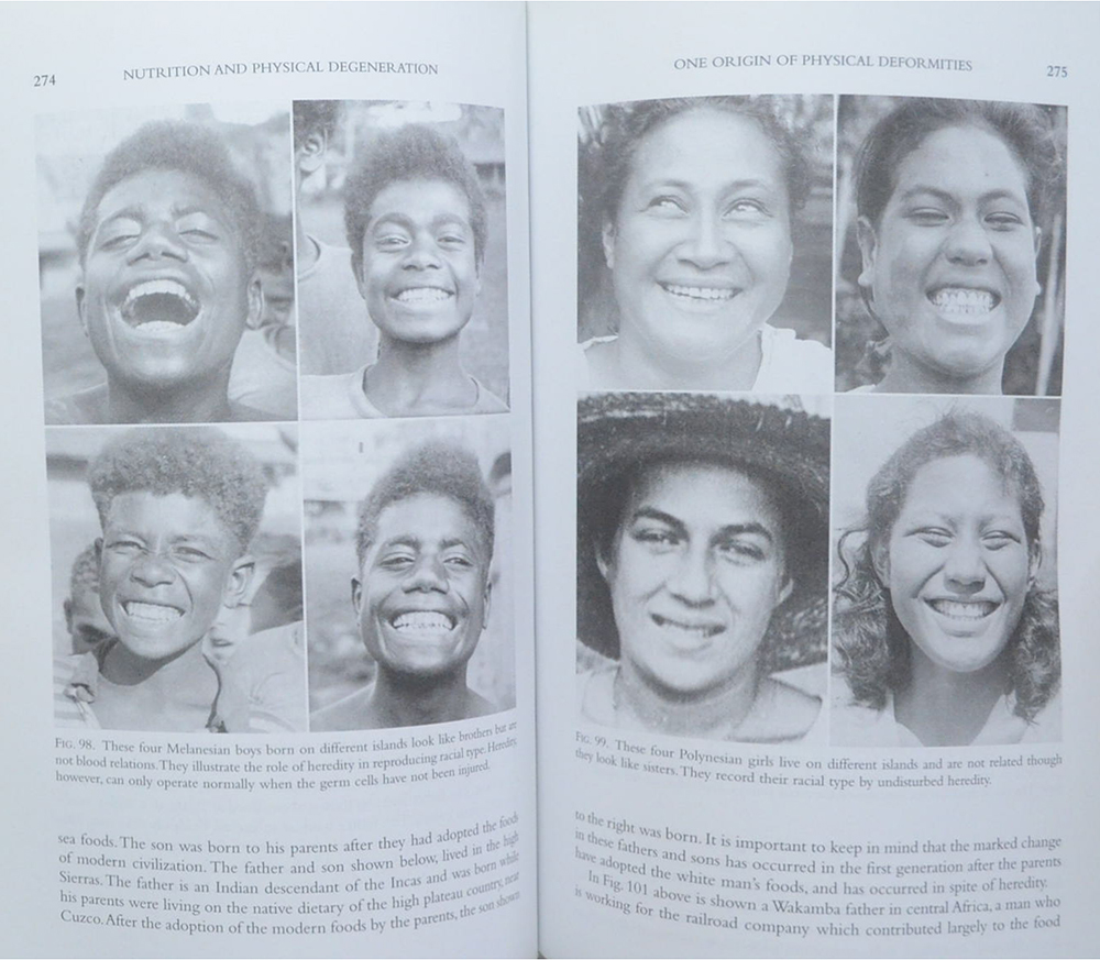 Nutrition and Physical Degeneration